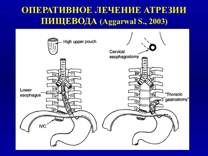 ОПЕРАТИВНОЕ ЛЕЧЕНИЕ АТРЕЗИИ ПИЩЕВОДА (Aggarwal S., 2003)