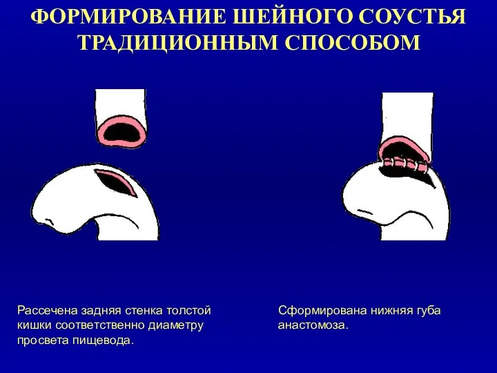 ФОРМИРОВАНИЕ ШЕЙНОГО СОУСТЬЯ ТРАДИЦИОННЫМ СПОСОБОМ Рассечена задняя стенка толстой кишки соответственно