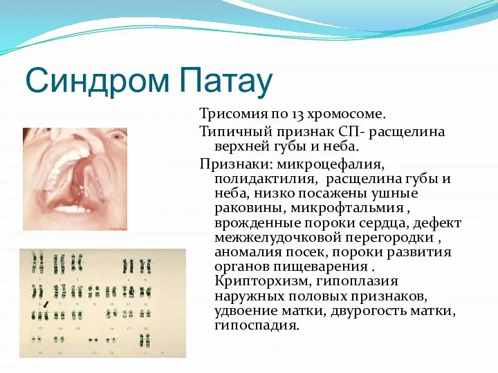 Синдром Патау Трисомия по 13 хромосоме. Типичный признак СП- расщелина верхней