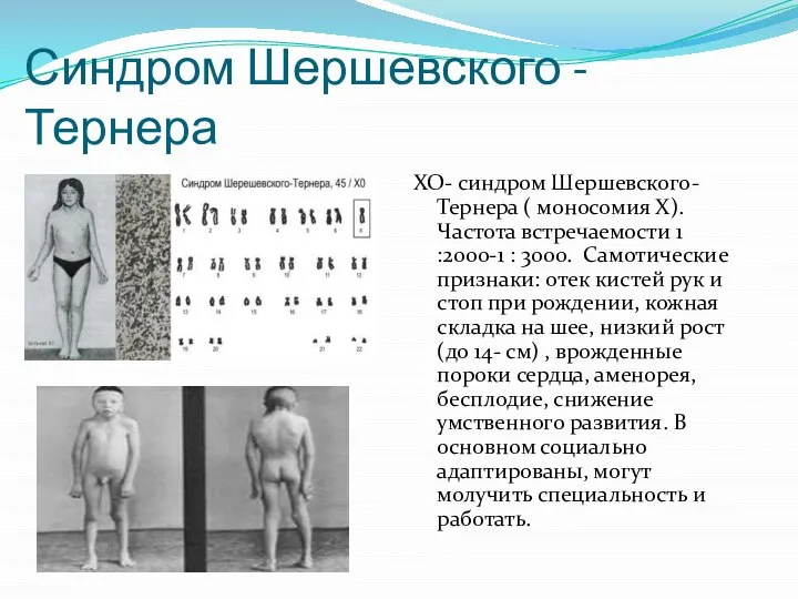 Синдром Шершевского - Тернера ХО- синдром Шершевского- Тернера ( моносомия Х).