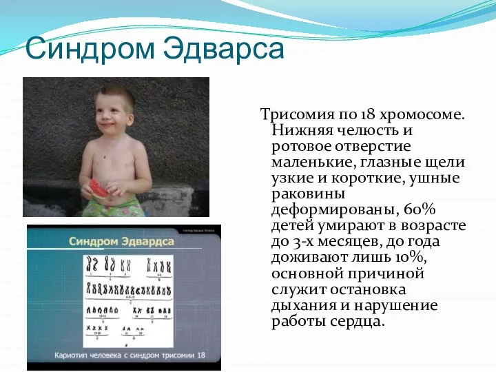 Синдром Эдварса Трисомия по 18 хромосоме. Нижняя челюсть и ротовое отверстие