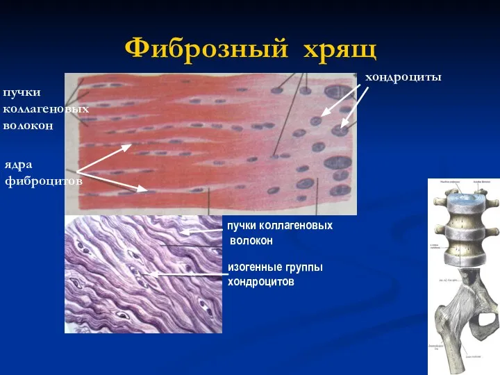 Фиброзный хрящ пучки коллагеновых волокон ядра фиброцитов хондроциты пучки коллагеновых волокон изогенные группы хондроцитов