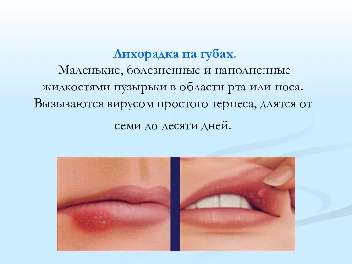 Лихорадка на губах. Маленькие, болезненные и наполненные жидкостями пузырьки в области