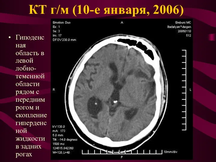 КТ г/м (10-е января, 2006) Гиподенсная область в левой лобно-теменной области