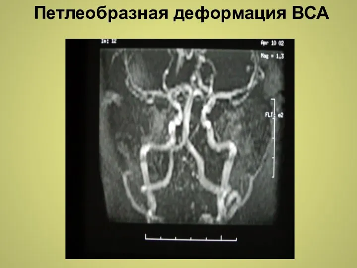 Петлеобразная деформация ВСА