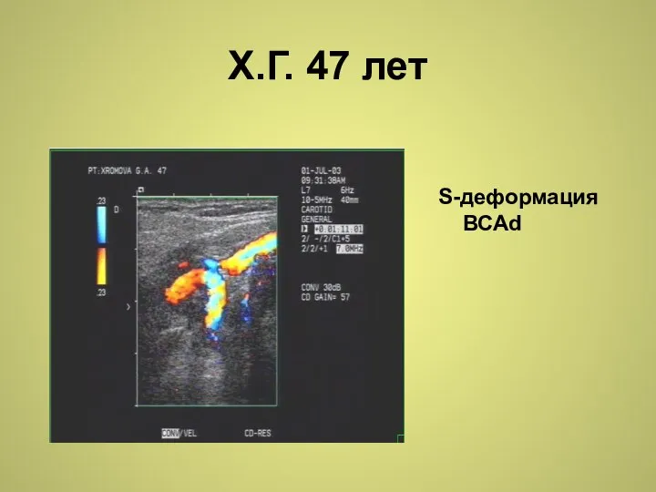 Х.Г. 47 лет S-деформация ВСАd