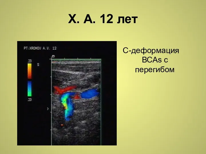 Х. А. 12 лет С-деформация ВСАs с перегибом