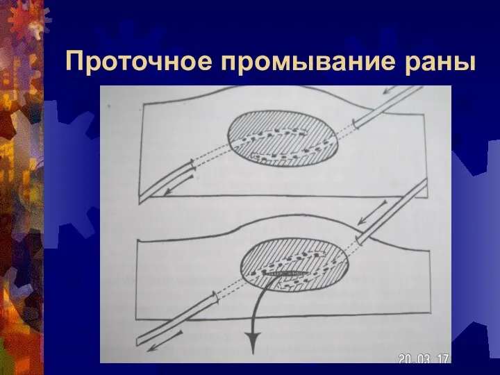 Проточное промывание раны