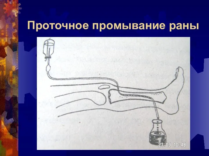 Проточное промывание раны