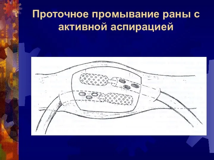 Проточное промывание раны с активной аспирацией