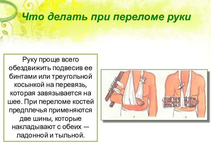 Что делать при переломе руки Руку проще всего обездвижить подвесив ее