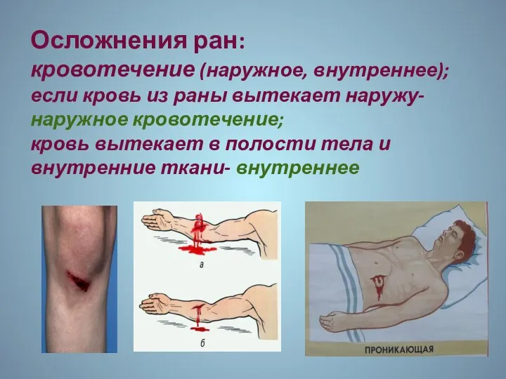 Осложнения ран: кровотечение (наружное, внутреннее); если кровь из раны вытекает наружу-