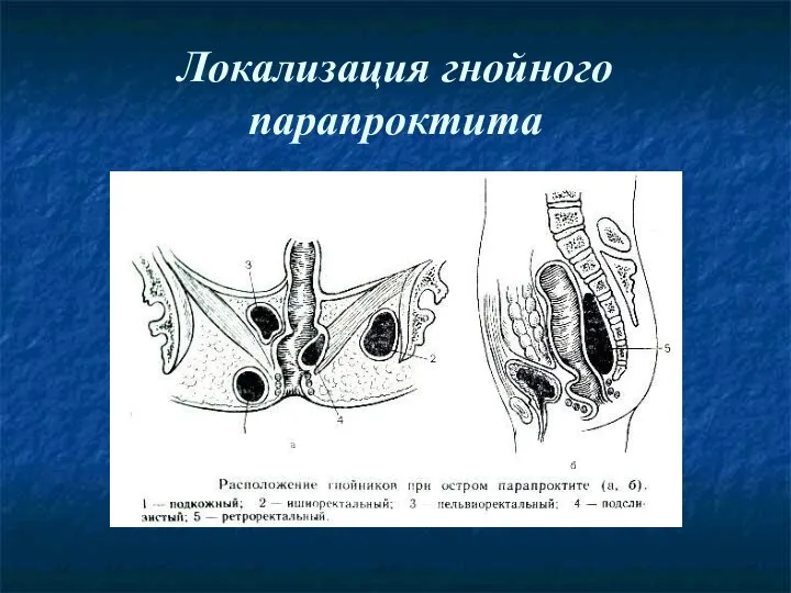 Локализация гнойного парапроктита