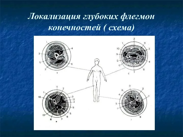 Локализация глубоких флегмон конечностей ( схема)