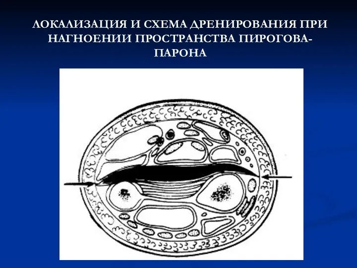 ЛОКАЛИЗАЦИЯ И СХЕМА ДРЕНИРОВАНИЯ ПРИ НАГНОЕНИИ ПРОСТРАНСТВА ПИРОГОВА-ПАРОНА