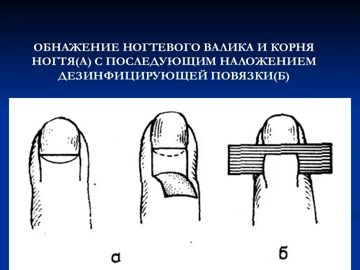 ОБНАЖЕНИЕ НОГТЕВОГО ВАЛИКА И КОРНЯ НОГТЯ(А) С ПОСЛЕДУЮЩИМ НАЛОЖЕНИЕМ ДЕЗИНФИЦИРУЮЩЕЙ ПОВЯЗКИ(Б)