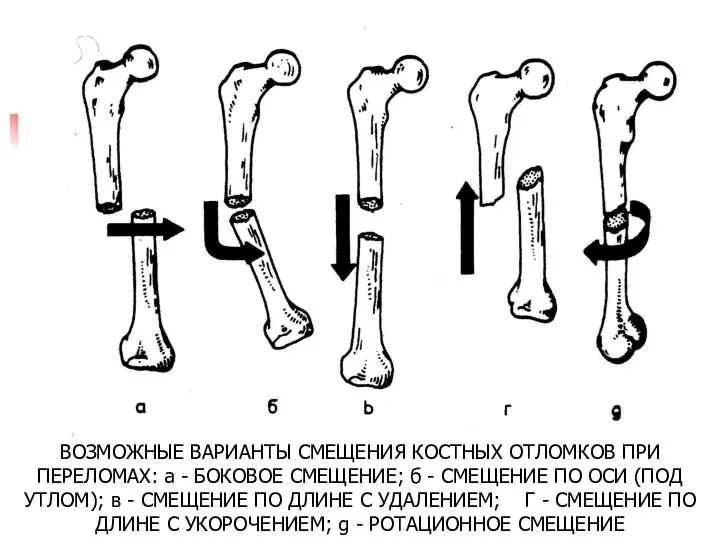 ВОЗМОЖНЫЕ ВАРИАНТЫ СМЕЩЕНИЯ КОСТНЫХ ОТЛОМКОВ ПРИ ПЕРЕЛОМАХ: а - БОКОВОЕ СМЕЩЕНИЕ;