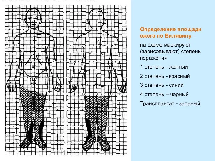 Определение площади ожога по Вилявину – на схеме маркируют(зарисовывают) степень поражения