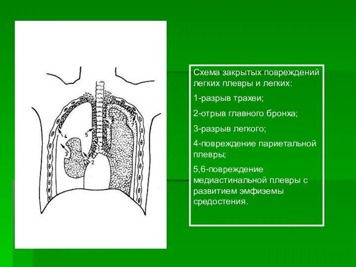 Схема закрытых повреждений легких плевры и легких: 1-разрыв трахеи; 2-отрыв главного