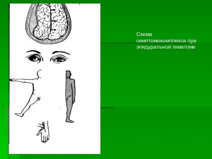 Схема симптомокомплекса при эпидуральной гематоме