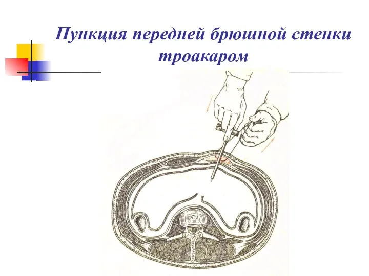 Пункция передней брюшной стенки троакаром