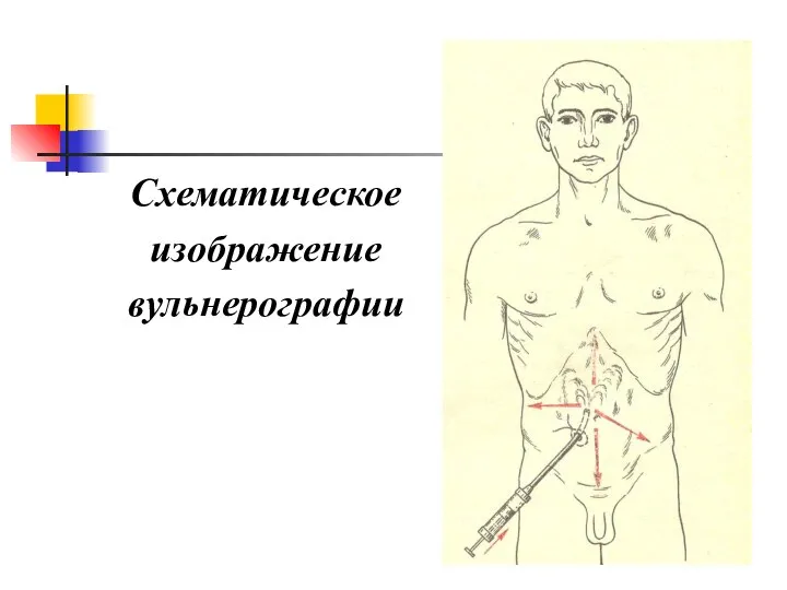 Схематическое изображение вульнерографии