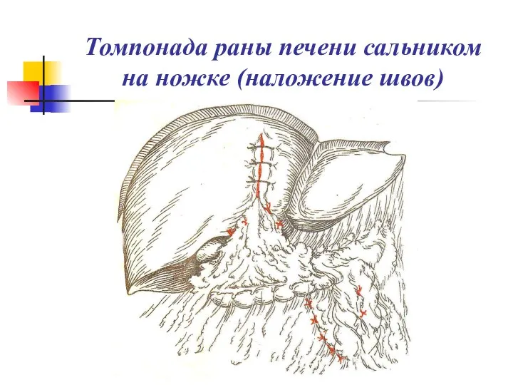 Томпонада раны печени сальником на ножке (наложение швов)