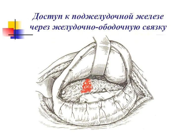 Доступ к поджелудочной железе через желудочно-ободочную связку