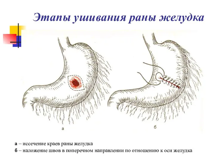 Этапы ушивания раны желудка а – иссечение краев раны желудка б