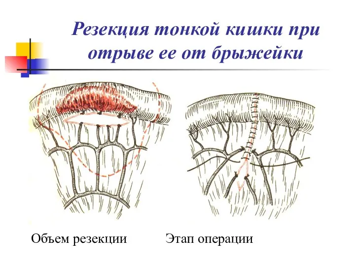 Резекция тонкой кишки при отрыве ее от брыжейки Объем резекции Этап операции