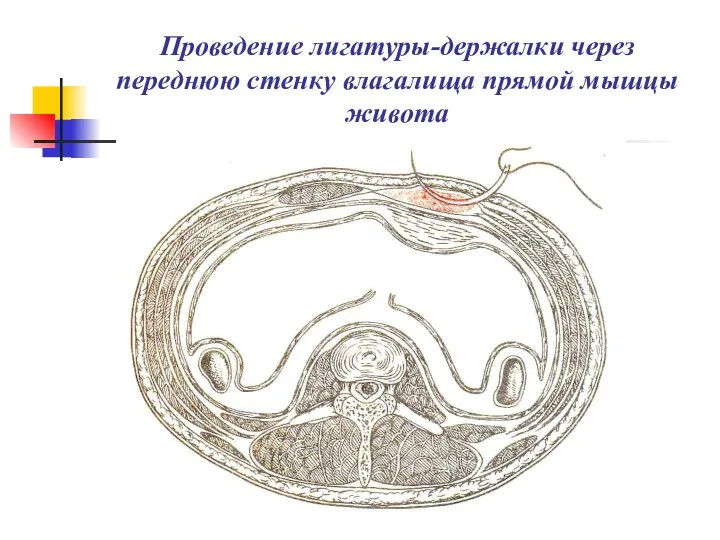 Проведение лигатуры-держалки через переднюю стенку влагалища прямой мышцы живота