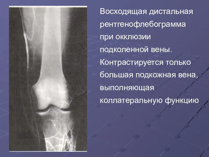 Восходящая дистальная рентгенофлебограмма при окклюзии подколенной вены. Контрастируется только большая подкожная вена, выполняющая коллатеральную функцию