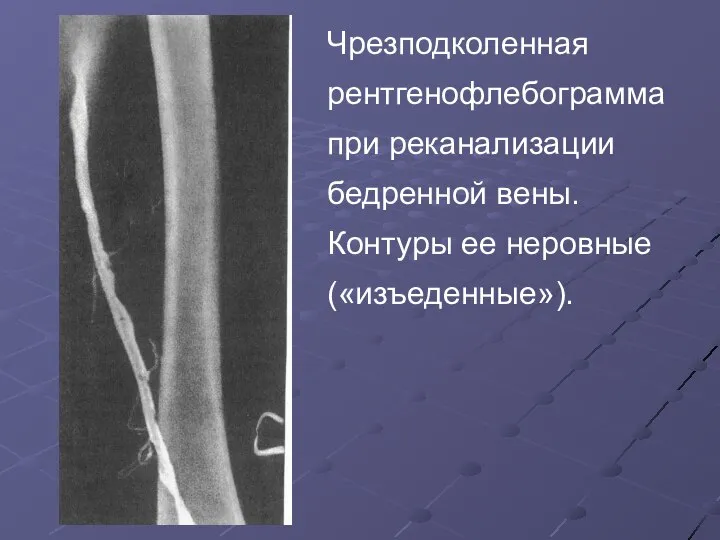 Чрезподколенная рентгенофлебограмма при реканализации бедренной вены. Контуры ее неровные («изъеденные»).