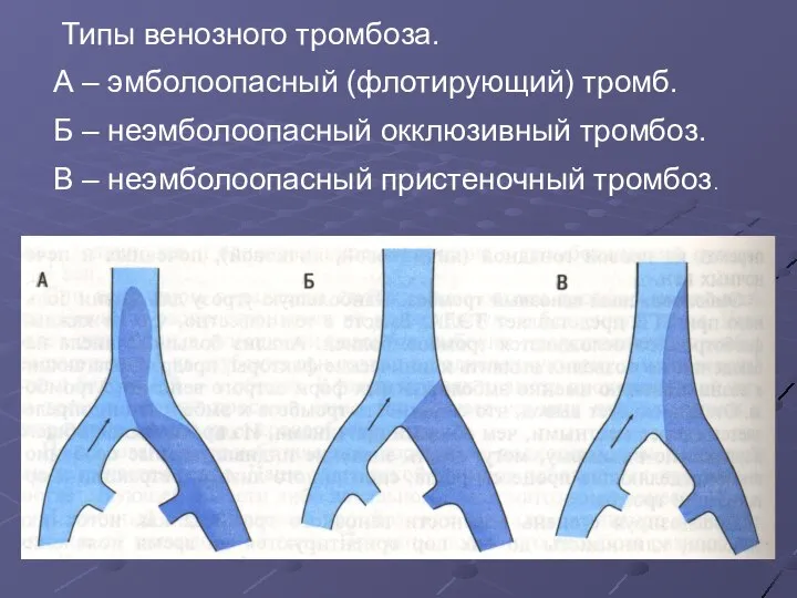 Типы венозного тромбоза. А – эмболоопасный (флотирующий) тромб. Б – неэмболоопасный