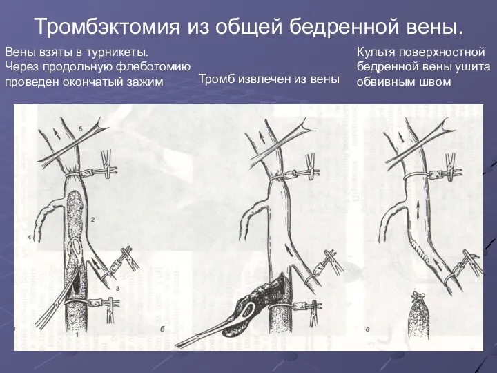 Тромбэктомия из общей бедренной вены. Вены взяты в турникеты. Через продольную