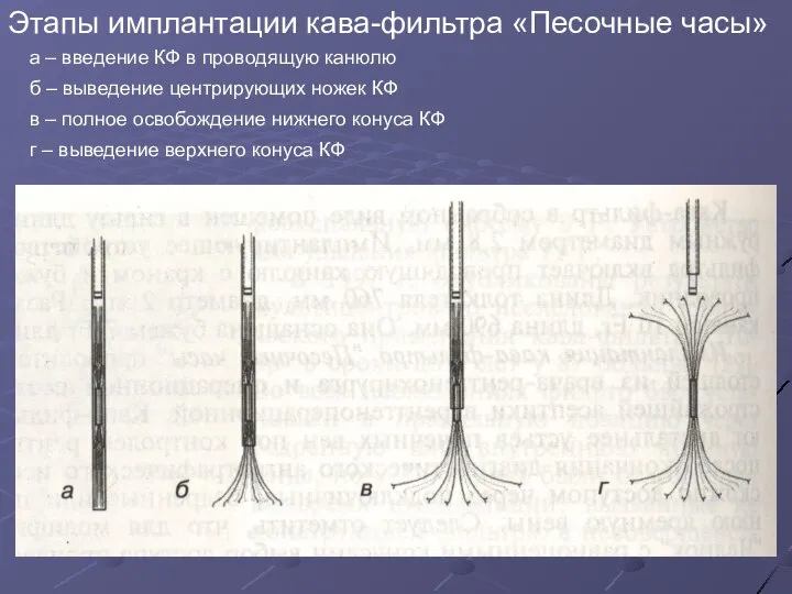 Этапы имплантации кава-фильтра «Песочные часы» а – введение КФ в проводящую