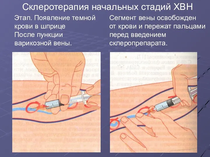 Склеротерапия начальных стадий ХВН Этап. Появление темной крови в шприце После