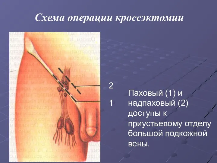 1 2 Паховый (1) и надпаховый (2) доступы к приустьевому отделу