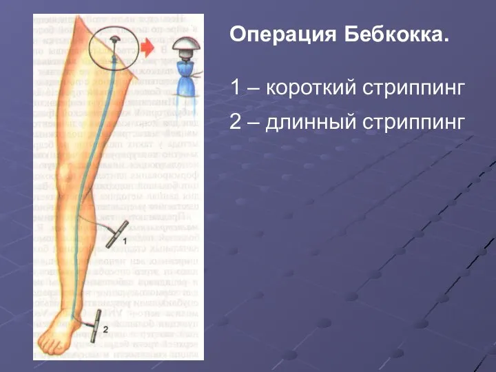 Операция Бебкокка. 1 – короткий стриппинг 2 – длинный стриппинг