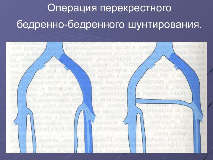 Операция перекрестного бедренно-бедренного шунтирования.