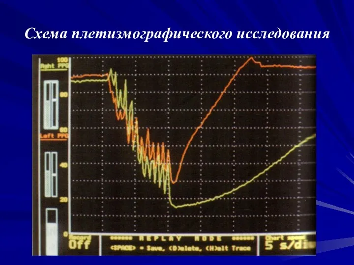 Схема плетизмографического исследования