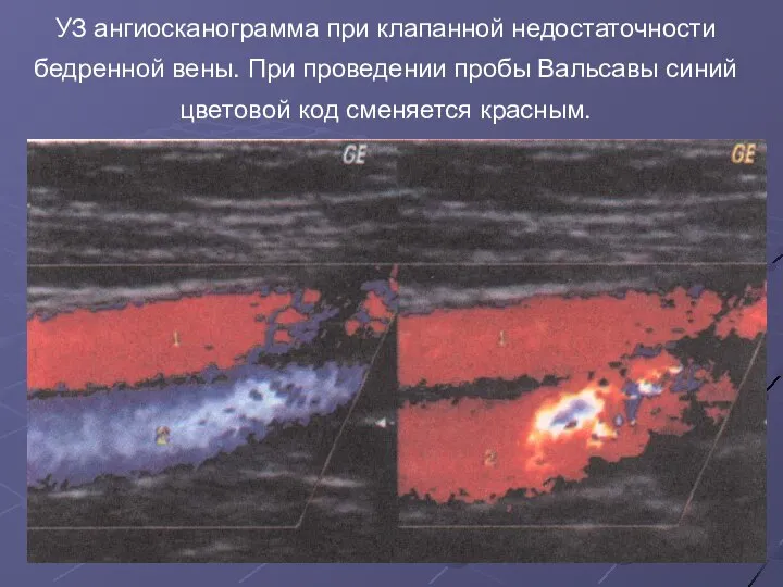 УЗ ангиосканограмма при клапанной недостаточности бедренной вены. При проведении пробы Вальсавы синий цветовой код сменяется красным.