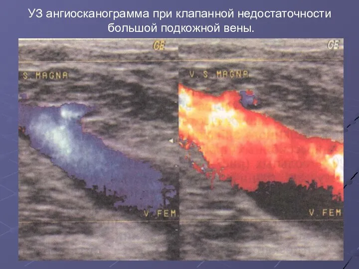 УЗ ангиосканограмма при клапанной недостаточности большой подкожной вены.