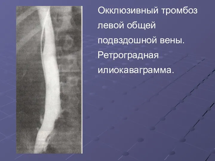 Окклюзивный тромбоз левой общей подвздошной вены. Ретроградная илиокаваграмма.