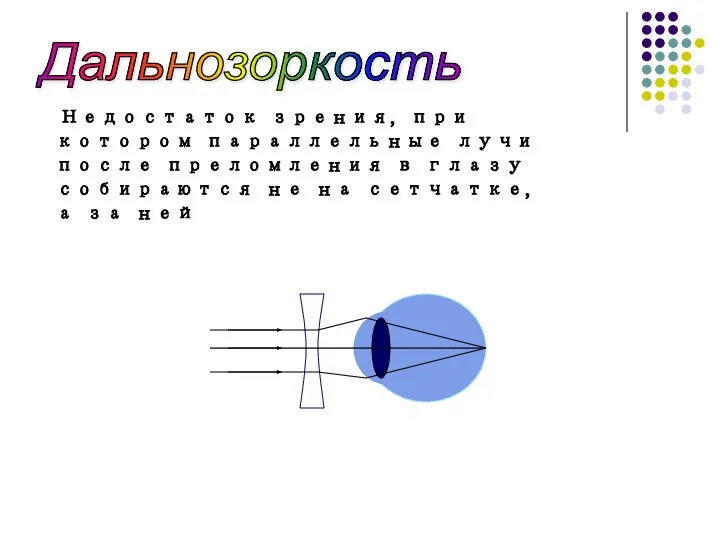 Дальнозоркость Недостаток зрения, при котором параллельные лучи после преломления в глазу