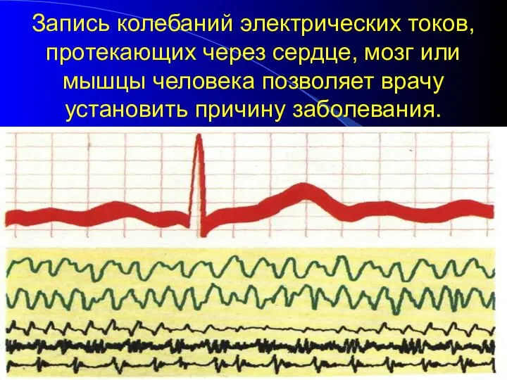 Запись колебаний электрических токов, протекающих через сердце, мозг или мышцы человека позволяет врачу установить причину заболевания.