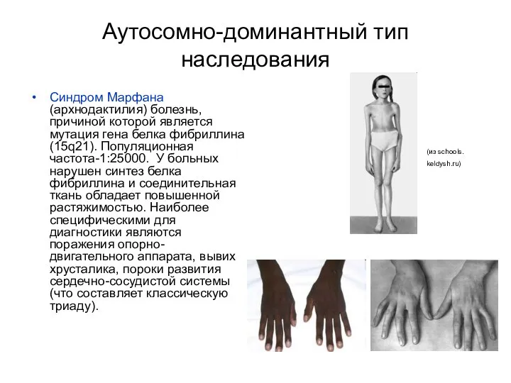 Аутосомно-доминантный тип наследования Синдром Марфана (архнодактилия) болезнь, причиной которой является мутация