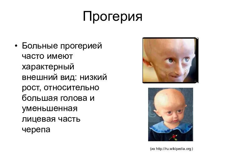 Прогерия Больные прогерией часто имеют характерный внешний вид: низкий рост, относительно