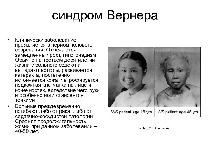 синдром Вернера Клинически заболевание проявляется в период полового созревания. Отмечаются замедленный