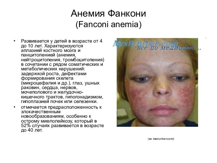 Анемия Фанкони (Fanconi anemia) Развивается у детей в возрасте от 4